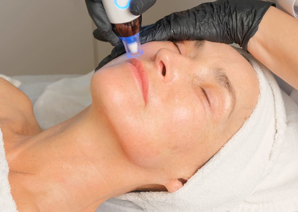 A woman receiving RF microneedling treatment on her face at a medical aesthetics clinic, showing a close-up of the device tightening skin and improving texture.